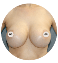 bruststraffung-aegz-1