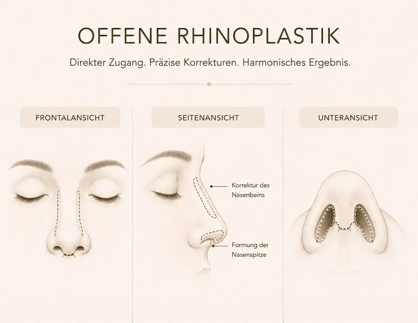 offene-rhinoplastik-1