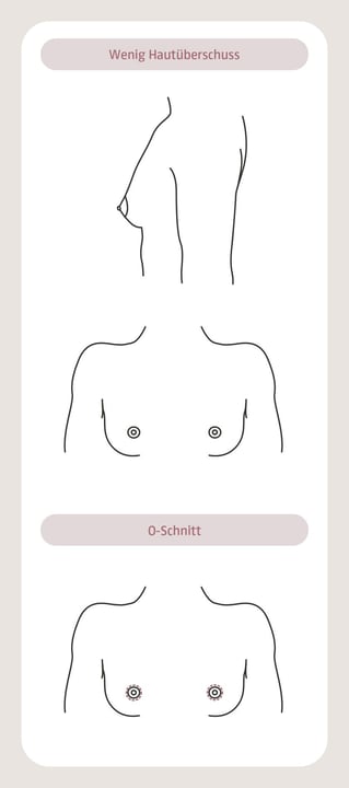 plastische-chirurgie-brust-1-aegz-darmstadt