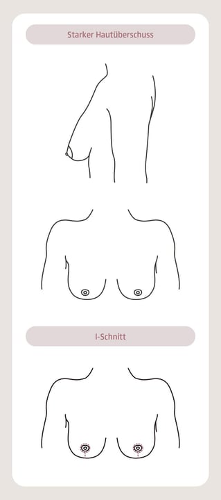 plastische-chirurgie-brust-2-aegz-darmstadt