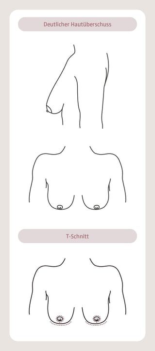 plastische-chirurgie-brust-3-aegz-darmstadt