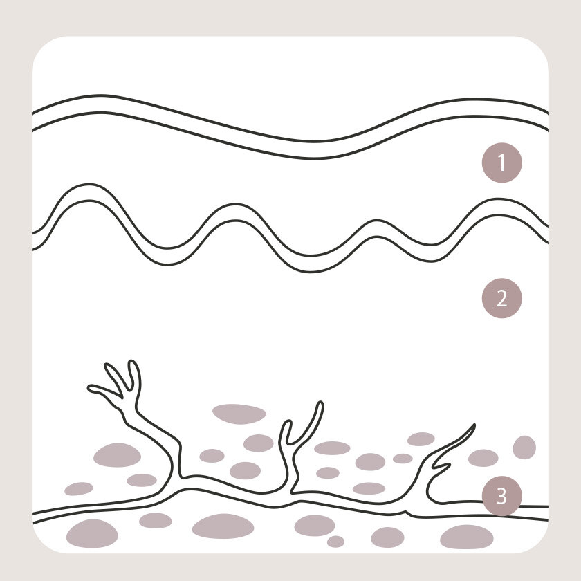 Illustration von normalem Fettgewebe zur Abgrenzung gegenüber krankhaft verändertem Gewebe bei Lipödem.